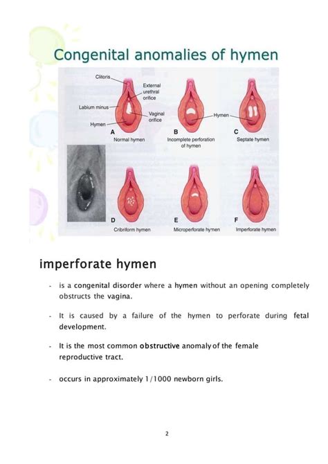 imperforate hymen|Imperforate hymen: MedlinePlus Medical Encyclopedia